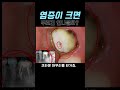 잇몸이 부어서 너무 아파요😭치아머리 크기만한 염증😱😱 재신경치료로 붓기는 없애고😲염증은 줄었어요❗