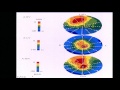 Emory Cardiology Grand Rounds 02-27-2017