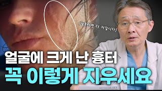 얼굴 흉터, 잘못 제거하면 더 심해집니다