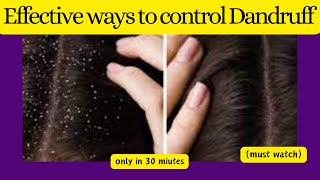 10 best Effective ways to control Dandruff|  miss healthy