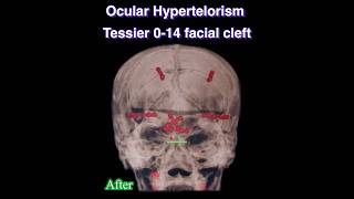 Ocular Hypertelorism आंखों के बीच ज्यादा दूरी కళ్ల మధ్య ఎక్కువ దూరం #Free #Surgery GSR #hospital