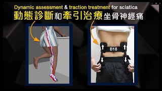 動態診斷和牽引治療坐骨神經痛 Dynamic assessment \u0026 traction treatment for sciatica | 病人見證 | B18