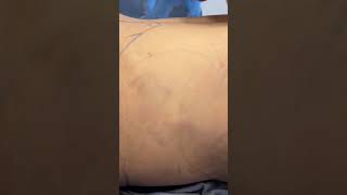 Liposuction #liposuction #lipo #plasticsurgery #plasticsurgeon