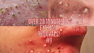 Over 20 Minutes Of Of EXTREME Cyst Removals | Black And White Heads | Mouth Cyst | Extreme Pops #1