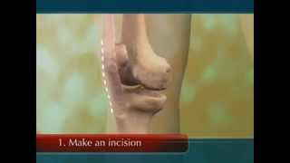 Knee Replacement Educational video