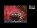 Lecture: Scleral and Corneal Inflammatory Disorders