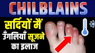 Chilblains : सर्दी में सूज जाते हैं हाथ पैर | Swollen hands and fingers in Winter | Axico Ayurveda