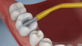 Remoção da Cárie e Restauração de um Dente