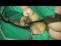 root canal retreatment gutta percha removal