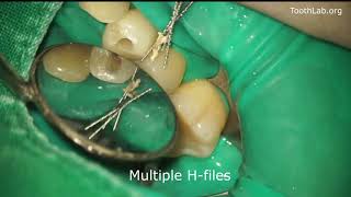 Root canal retreatment-Gutta percha removal