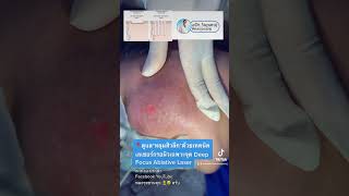 📍ดูแล*หลุมสิวลึก*ด้วยเทคนิคเลเซอร์กรอผิวเฉพาะจุด Deep Focus Ablative Laser#หลุมสิว #รักษาหลุมสิว