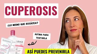 ⏩ What is CUPEROSIS? How is it TREATED? 🤔 + PRODUCTS I RECOMMEND ✅⚡