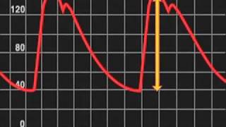 What is Pulse Pressure ?
