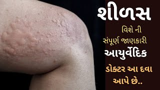 શીળસ વિશે સંપૂર્ણ માહિતી અને ઉપચાર- urticaria Treatment In Gujarati || Medicine9