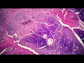 Mucoepidermoid Carcinoma, High Grade