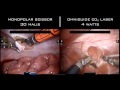 Robotic Excision of Endometriosis. Monopolar Energy vs. CO2 Laser