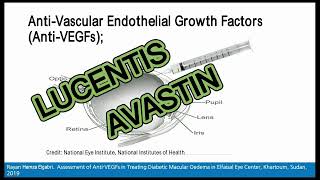 Anti-VEGFs in treating diabetic macular edema - Video abstract [ID 338926]