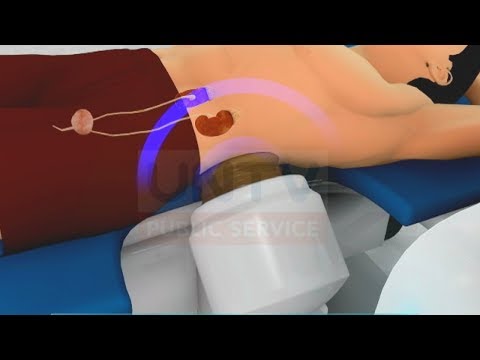 Kidney Stones: Actual ESWL procedure Kidney Stones: Actual ESWL procedure