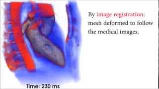 Intracardiac flow in a patient-specific heart model