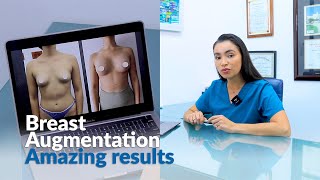 Amazing Results with Breast Augmentation