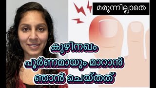 കുഴിനഖം പൂർണമായും മാറാൻ ഞാൻ ചെയ്തത് /How to Fix Ingrown Toenails at Home/Clouda Tijo