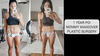 1 YEAR PostOp- Mommy Makeover Plastic Surgery!! #tummytuck #mmo #mommymakeover