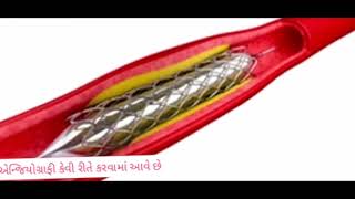 angiography કેવી રીતે કરવામાં આવે છે,હૃદય રોગનું સમાધાન, હૃદયમાં સ્ટેન્ડ કેવી રીતે બેસાડવામાં આવે છે