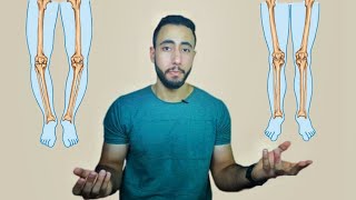 علاج تقوس الساقين للخارج  genu varum- Bow legs