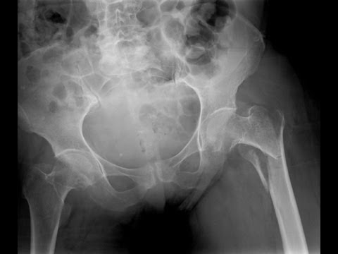 How Osteoporosis Is Diagnosed How Osteoporosis Is Diagnosed