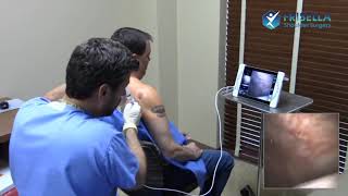 Awake In-Office Shoulder Arthroscopy Frisella Shoulder Surgery