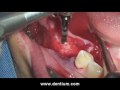 dentium dental implant prosthetic 45 46 47 8 .wmv