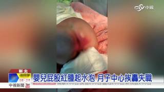 【中視新聞】嬰兒屁股紅腫起水泡 月子中心失職?!  20151003