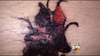 Dr. Max Gomez: Tattoos Can Come With Unexpected Health Risks