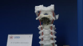 World's First 3D-print Spinal Implant Done in Beijing Hospital