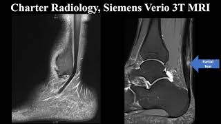 High-grade Partial Achilles Tendon Tear