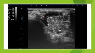 Echographie d'un kyste poplité (bursite du semi membraneux)