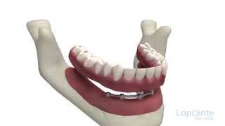Full denture on implants - Lapointe dental centres