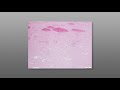 Fine Needle Aspiration Biopsy (FNA) Techniques - Sampling Highly Vascular Targets