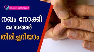 നഖം നോക്കി രോഗങ്ങൾ തിരിച്ചറിയാം | Diseases can be identified by looking at the nails |