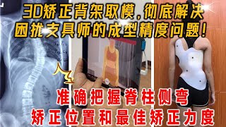 脊柱侧弯的保守治疗-3D矫正支具