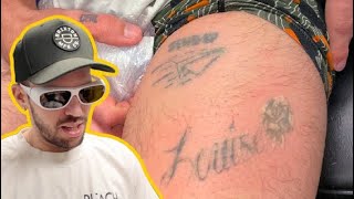 Removing All of My Tattoos!