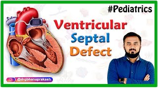 Ventricular Septal Defect : Etiology, Pathophysiology, Clinical features, Diagnostics, Treatment