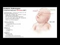 torticollis → mechanism pathophysiology u0026 effects in infants