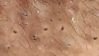 Satisfying Acne and Pimple Removal Blackheads & Whiteheads #1373