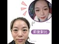 真實見證 李小姐去眼袋變年輕的秘密 美詩沁macys