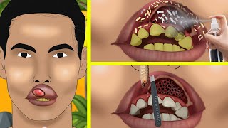 💟 ASMR ☮️ Maggots Mouth & Lip Infection Treatment SATISFYING Animation