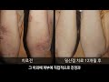 습진 eczema 습진 원인과 습진 관리법 습진 치료법 궁금해요