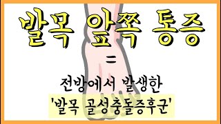 발목 골성충돌증후군 시리즈 3 - 원인, 증상, 검사