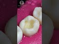 repairing dental caries toothrestoration shorts