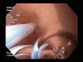 endoscopic treatment of ugib upper gi bleeding